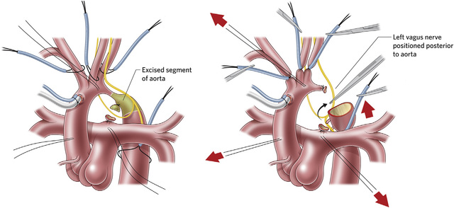 Skeletonization of the Recurrent Laryngeal Nerve.jpg