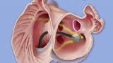 医学动画：房颤治疗新方法