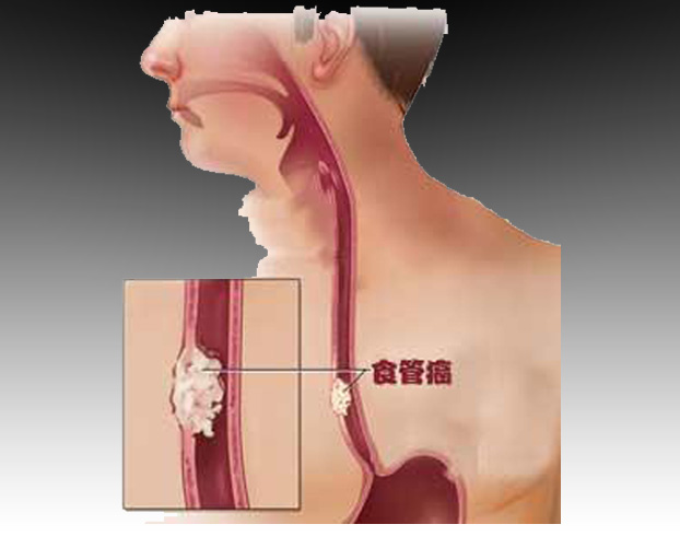 医学动画：带你了解食管癌