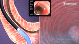 医学动画：消化内镜--POEM手术