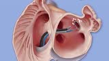 医学动画：传统房颤治疗方法