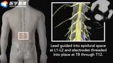 医学动画：脊髓刺激术的临床应用