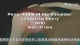 医学动画：带你了解肩周炎