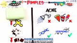 医学动画：痘痘是怎么长出来的？