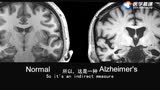 阿尔茨海默病的特性成像