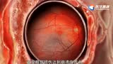 医学动画：高血压对眼部的损伤