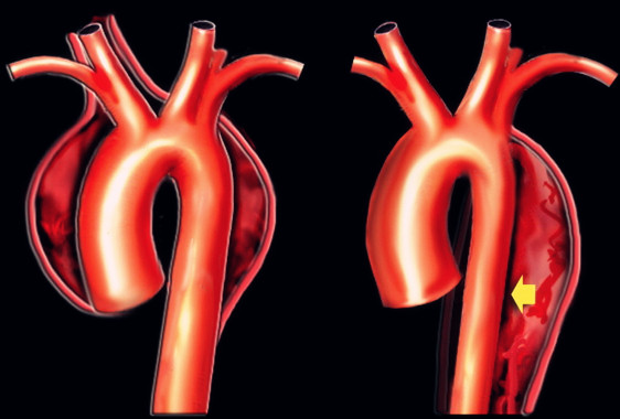 医学动画：主动脉瘤与夹层