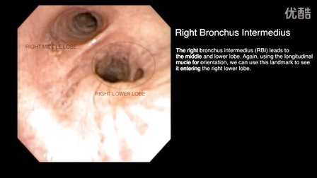 [生活]纤支镜引导气管插管(新英格兰杂志)